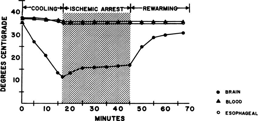 Hypothermia and Circulatory Arrest in Dog Brain 1005 Fro. 8. Temperature gradient between the brain and other organs produced during differential cerebral hypothermic perfusion.