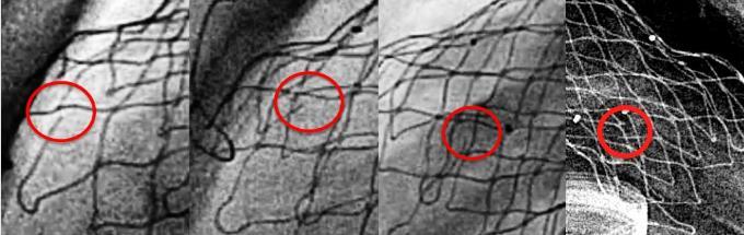 Venus P-valve Fluroscopy follow-up: Single wire fracture 4 cases (earliest