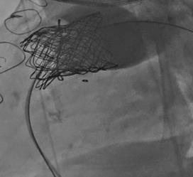bioprosthesis Pre-stenting with a bare 10 ZIG CP stent