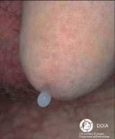 CHLAMYDIA PUBIC LICE Symptoms usually appear as early as 1 day or as late as 12 days after sexual contact