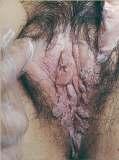 CANDIDIASIS GENITAL WARTS Foul smelling and cheesy