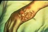SYPHILIS THIRD STAGE GENITAL HERPES Presence of