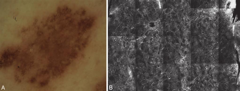 Figure 2. Benign melanocytic nevus: (A) dermoscopy and (B) reflectance confocal microscopy mosaic shows ring pattern with edged papillae and no atypical cells. pigment-rich keratinocytes.