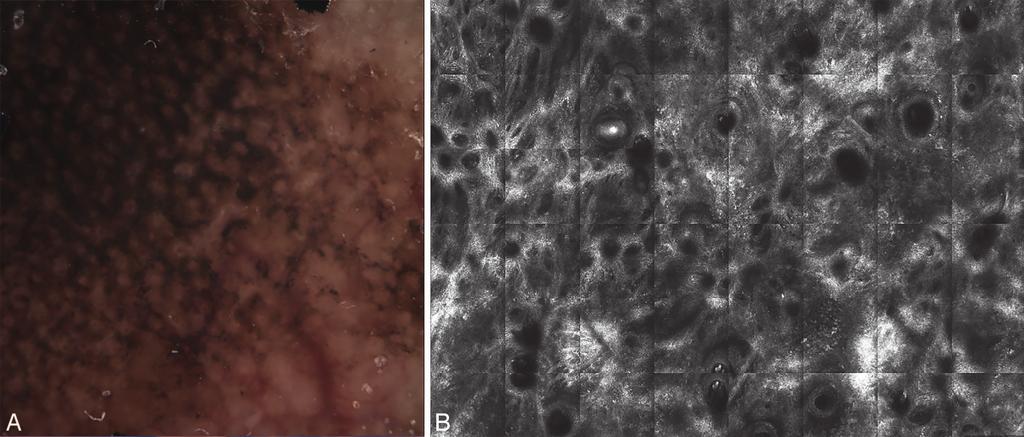 11 A retrospective analysis of 143 cases of squamous cell carcinoma using RCM by Manfredini et al 12 showed characteristic RCM features of polymorphic vessels, erosion/ulceration, architectural