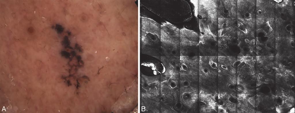 Figure 4. Basal cell carcinoma: (A) dermoscopy and (B) reflectance confocal microscopy mosaic shows tumor nodules with peripheral palisading, clefting, and streaming. 64.1% to 99.