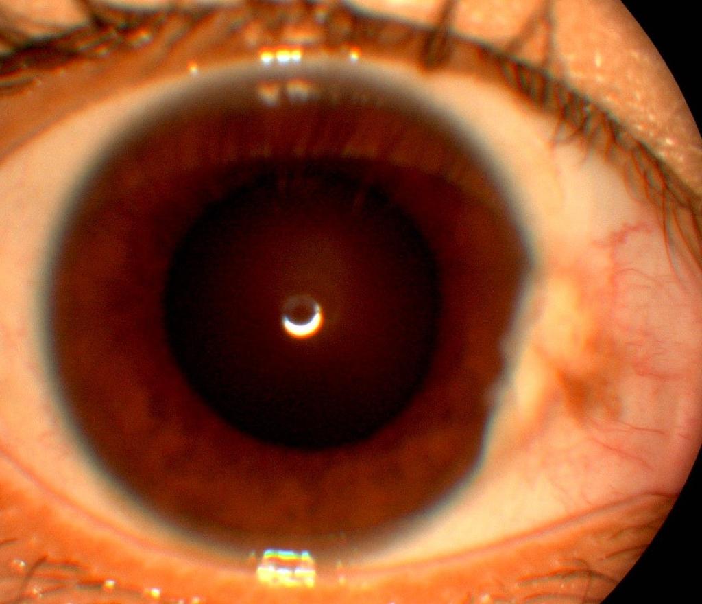 RAMALINGAM et al. Brunei Int Med J. 2011; 7 (1): 9 cause significant alteration in visual function. They also can become inflamed, resulting in redness and ocular irritation.
