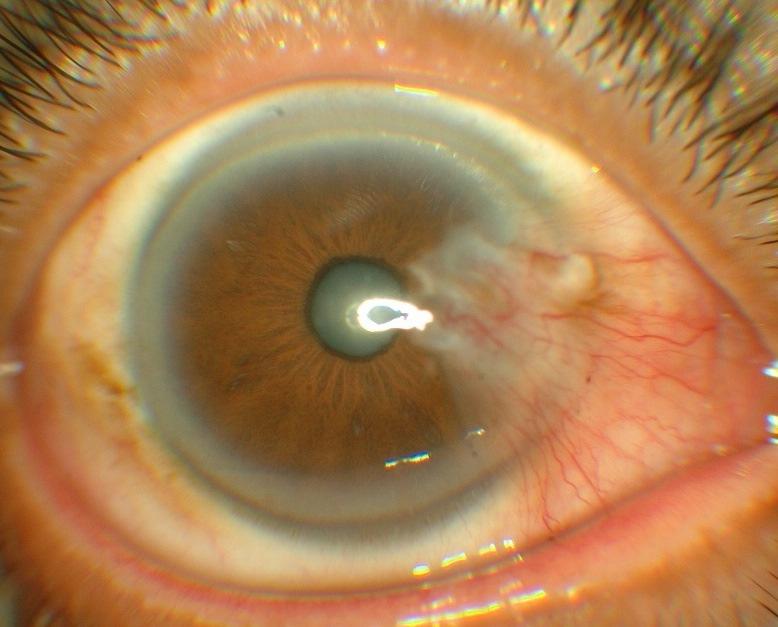 1 This is possibly due to the higher exposure to ultraviolet light (UV-B), which is a known risk factor for the development of pterygium.