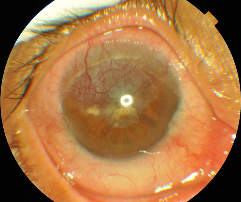 with good visual potential (1). However, thick pedunculated conjunctival flap with adherent Tenon s capsule may be able to provide stronger mechanical support for the cornea.