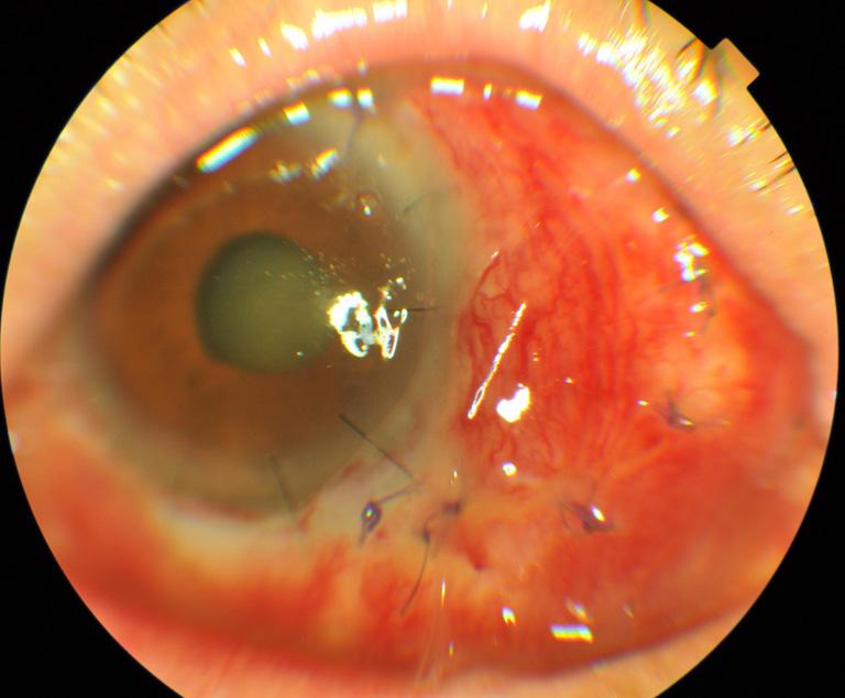 cyst and superior corneal