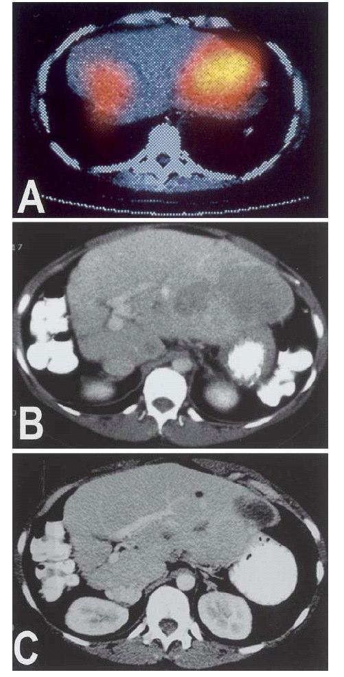 Fig. 2A C. Liver metastases from pancreatic insulinoma before and after 90 Y-DOTATOC therapy.