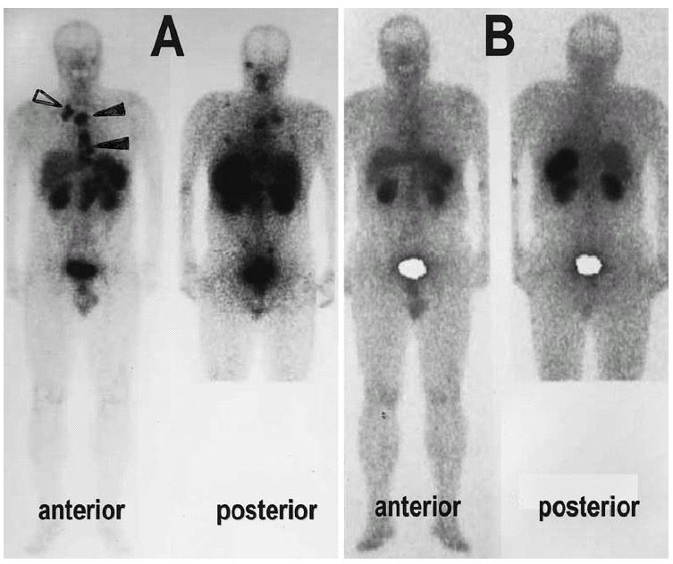 Fig. 3A, B. Bone and lymph node metastases from ileal carcinoid before and after 90 Y-DOTATOC therapy. A OctreoScan at recruitment.