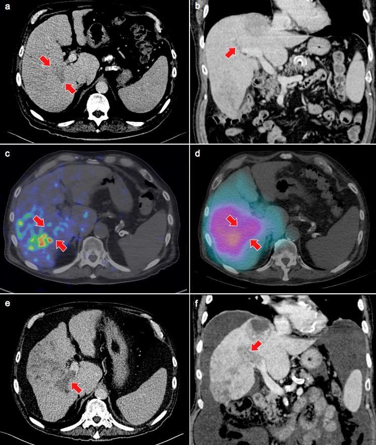 Baseline triphasic CT Liver Superior spatial resolution of Y-90 PET/CT confirms absence of activity