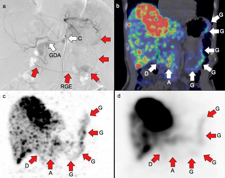 Superior spatial resolution of Y-90 PET/CT improves detection of non-target