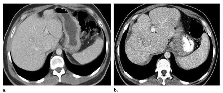 Capsular Retraction due to Hepatic Fibrosis and Portal