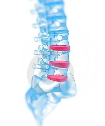 INDICATIONS OSTEOFLEX is indicated for the fixation of pathological fractures of the vertebral body using vertebroplasty or kyphoplasty procedures.