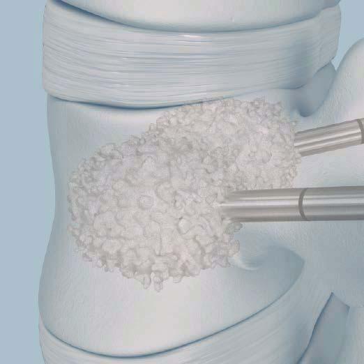 Inject PMMA Bone Cement Warning: Closely monitor the PMMA cement injection under fluoroscopy to reduce the risk of cement leakage. Severe leakage can cause death or paralysis.