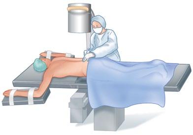 Affirm VCF System Surgical Technique Step 1. Approach and Instrument Selection Place the patient under local or general anesthesia in a prone position.