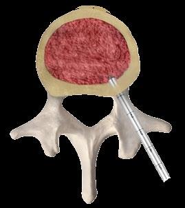 the soft tissue into the pedicle of the selected vertebra.