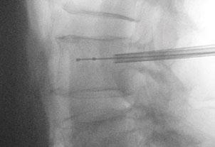 Verify the location of the bone tamp by identifying the radiopaque markers at both ends of the balloon under fluoroscopy, as shown below.