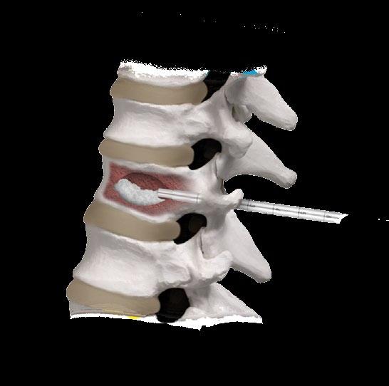 Cannula Filler Delivery Needle O-Ring Deliver Bone Cement into the vertebra under fluoroscopic guidance.