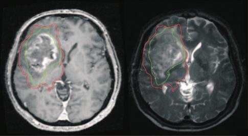 A gadolinium-enhanced T1-weighted (left) and T2-weighted (right) image from a 67-year-old man who presented with headaches and a left hemiparesis.
