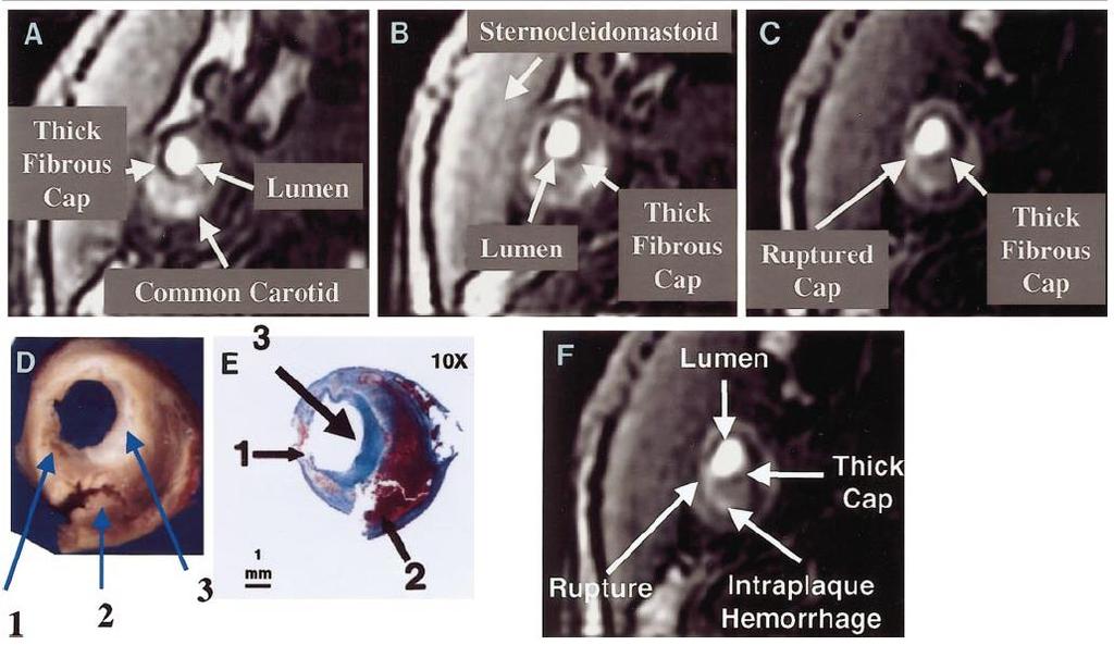 MRI of CAROTID PLAQUES Unstable Fibrous Cap