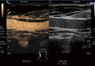 CEUS confirmed these results with enhancement demonstrated at the distal shoulder of the plaque extending from the adventitia into the plaque. Figure 4.