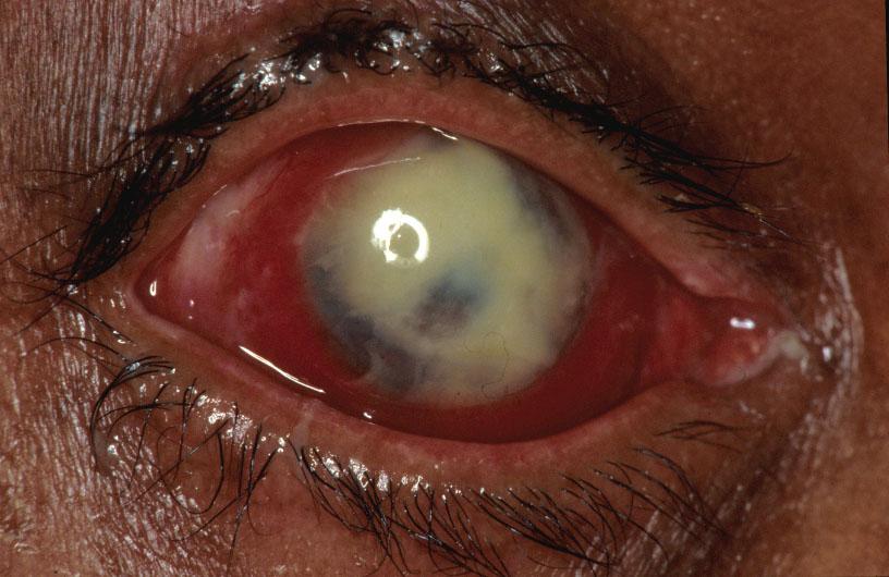 6 Keratitis Non specific signs of fungal keratitis include conjunctival injection; epithelial defect; suppuration;stromal infiltration; anterior chamber reaction; hypopyon; aqueous flare and corneal