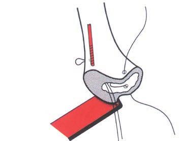 The lateral drill does not transfix the medullary cavity. Step 7: The lateral wire is inserted.