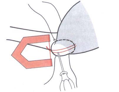 SURGICAL TECHNIQUE Step 9: After cementing the stem, and allowing for the cement to cure, a large awl is used to make a track in the bone at the central superior border of the greater trochanter.