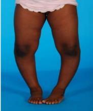 CASE #4 A 21-MONTH OBESE AFRICAN-AMERICAN GIRL WITH SEVERE BOWED LEGS AND FALLING. Uncomplicated pregnancy and delivery, full-term, SVD. Bottle fed, grew well and gained weight rapidly.