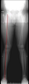 CASE #5 AN 11- YEAR OLD GIRL WITH FLAT FEET, AND PAIN IN BOTH