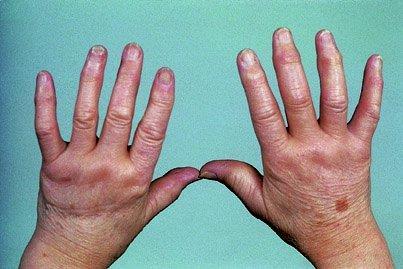 Symptoms & signs of inflammatory arthritis Joint pain Joint swelling