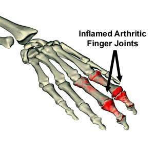 joints that are swollen