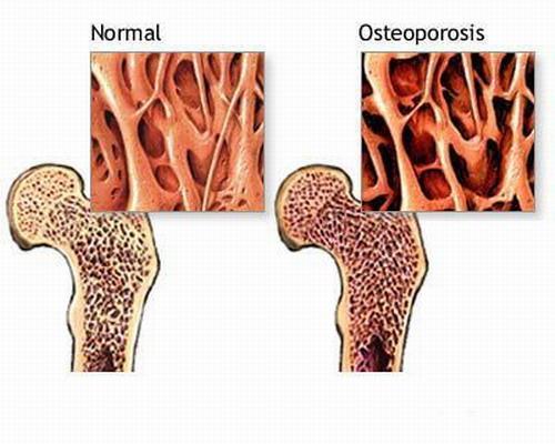 Osteoporosis risk Active inflammatory arthritis is a risk factor for the potential