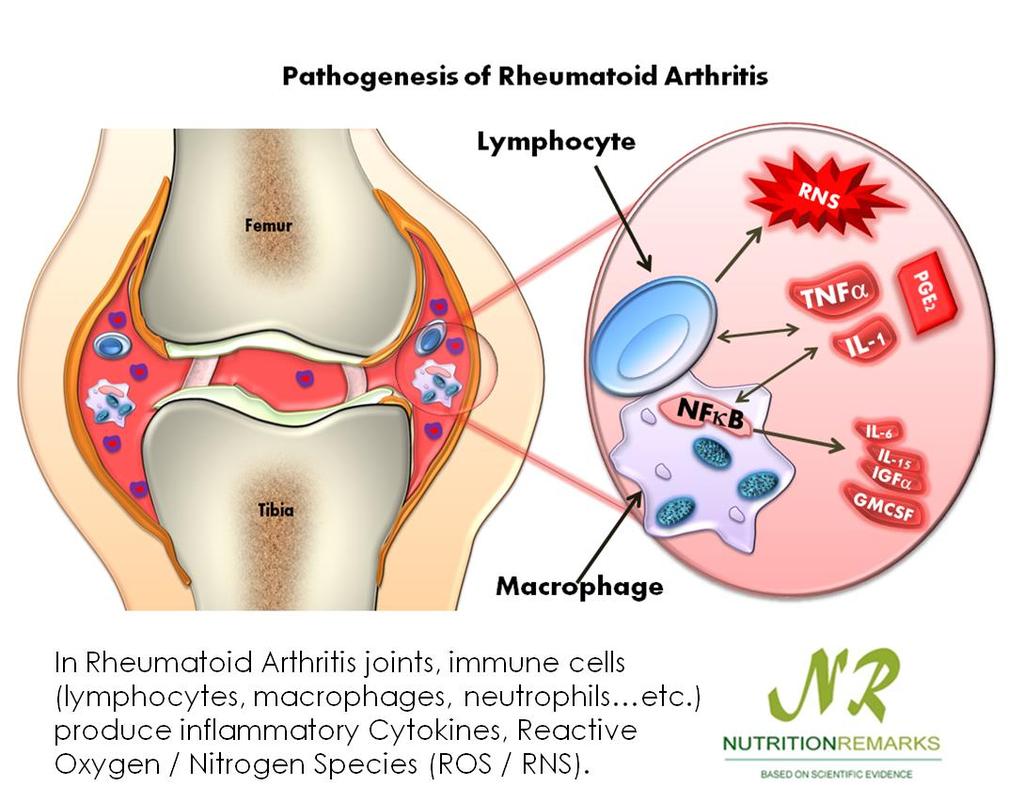 What causes inflammatory arthritis?