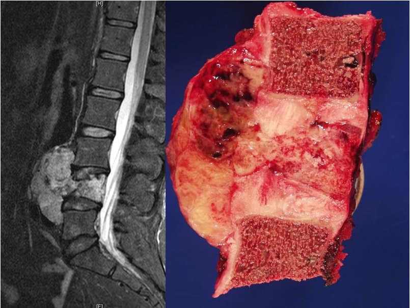 Conclusions Understanding the biology of spinal tumors is critical in defining the goal of