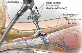 Step 5 Division of Gastrocnemius Aponeurosis 5-1 Temporarily remove the endoscope and insert it through the EGR cutting instrument, locking the two together with the