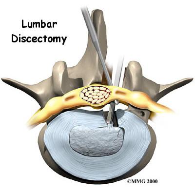 Surgeons perform lumbar discectomy surgery through an incision in the low back. This area is known as the posterior region of the low back.
