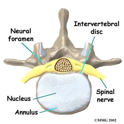 The Introduction Lumbar discectomy is a surgical procedure to remove part of a problem disc in the low back. The discs are the pads that separate the vertebrae.