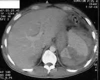 Multi variate analysis also observed the age group of 55 years in grade III to V splenic injuries, with moderate to large amounts of haemoperitoneum, the failure rate to be 30-40% [6, 7].