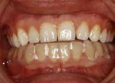 etween their teeth. If the ptient is n ctive ruxist, it is not uncommon for them to destroy such n pplince in firly short spce of time nd this cn e ccompnied y n excertion of their symptoms.