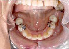 contcts etween mxillry nd mndiulr teeth will chnge in oth position nd numer. Get dvice out whether it is necessry to tret the disc displcement first efore plcement of the finl restortions. Q.