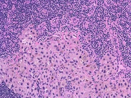 Diagnosis: Melanoma, with metastasis to lymph nodes History repeats