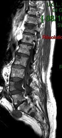 Case 2: 71; 10/2009: acromio-clavicular pain; PSA >2500 ng/ml, ALP 450 UI/L,