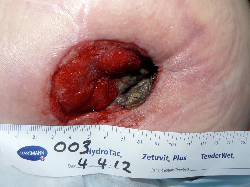 Difficult removal with bleeding Foam retention with infection Patient 3 (Granufoam ) displaying