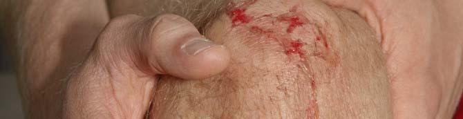 removing any type of dressing and cleaning a wound.