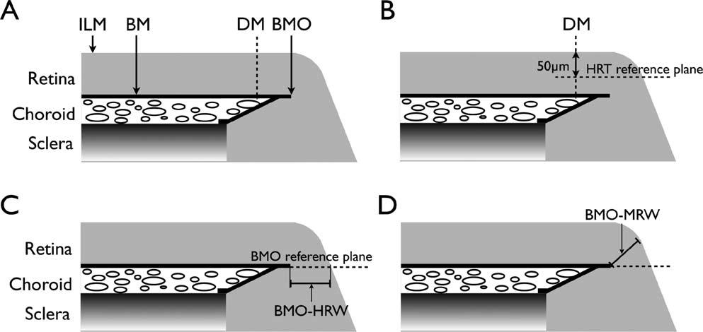 Structure Function Relationship in Glaucoma IOVS j January 2015 j Vol. 56 j No. 1 j 100 FIGURE 2. Schematic representations of the DM and the BMO-derived neuroretinal rim parameters.