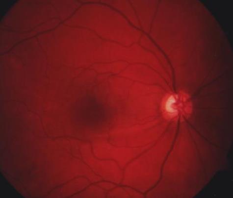 Study: Pattern of retinal thickness changes measured