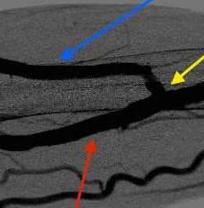 Radiocephalic Venography Central Veins HAND Cephalic vein (direction of flow IS towards the heart) Radial artery